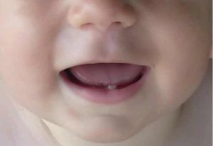 baby-teeth2